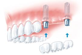 Ugodna cena zobnih implantatov  Cena zobnih implantatov
