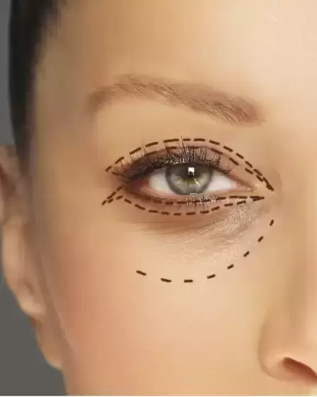 korekcija zgornjih vek s pomočjo blefaroplastike