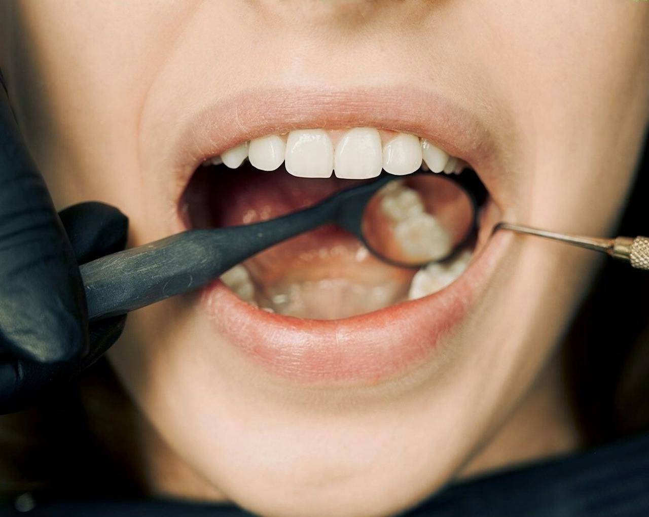 Vnetje dlesni - gingivitis